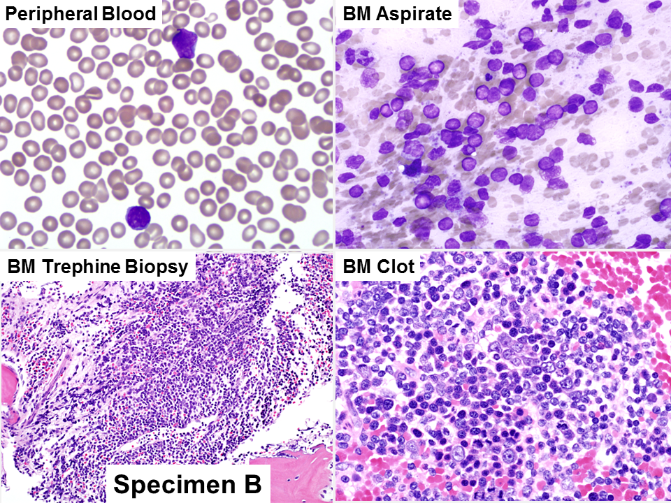 Peripheral blood and bone marrow, day 8 of induction therapy (B)